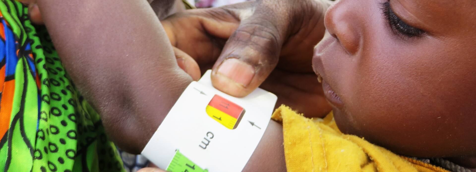 Kind mit MUAC-Band Kind mit MUAC-Band