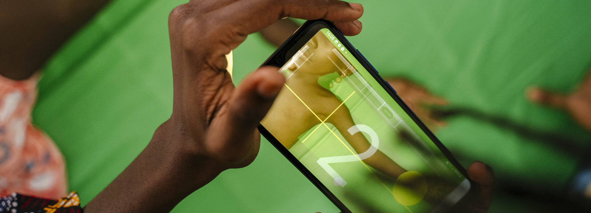 Mit unserer SAM Foto-App® können Kinder anhand von Fotos, die mit einer Smartphone-Kamera aufgenommen wurden, auf Mangelernährung untersucht werden.