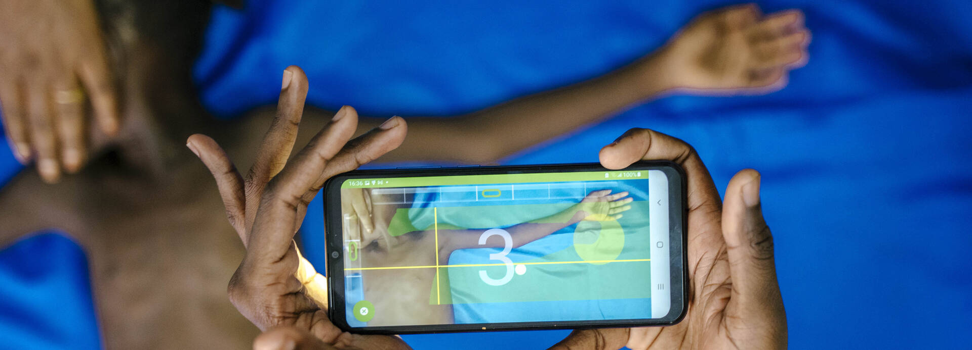 Ein Kind wird mithilfe der SAM-Foto-App auf Mangelernährung untersucht.