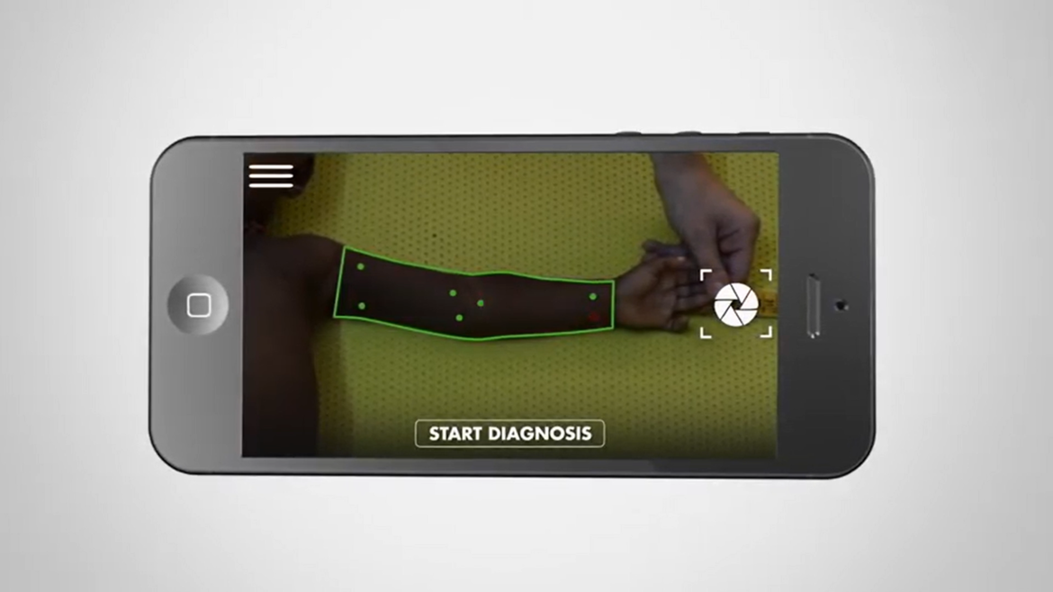 Screenshot der SAM-Foto-App, in der der Arm eines Kindes digital gemessen wird.