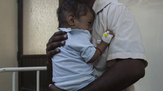 Akut mangelernährtes Kind in den Armen seines Vaters Akut mangelernährtes Kind in den Armen seines Vaters